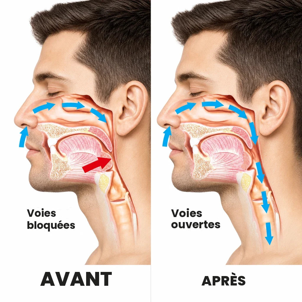 Voies respiratoires bloquées avant, ouvertes après SOMNÉA