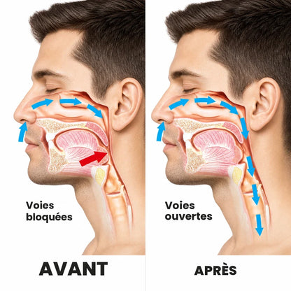 Voies respiratoires bloquées avant, ouvertes après SOMNÉA